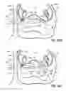 Fig. 43 - Systems, devices and methods for treating the heart with ablation
