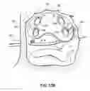 Fig. 46 - Systems, devices and methods for treating the heart with ablation