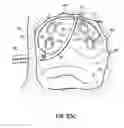 Fig. 47 - Systems, devices and methods for treating the heart with ablation
