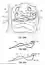 Fig. 48 - Systems, devices and methods for treating the heart with ablation