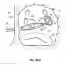 Fig. 53 - Systems, devices and methods for treating the heart with ablation