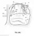 Fig. 54 - Systems, devices and methods for treating the heart with ablation