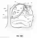 Fig. 55 - Systems, devices and methods for treating the heart with ablation