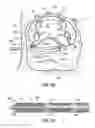 Fig. 64 - Systems, devices and methods for treating the heart with ablation