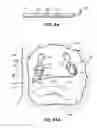 Fig. 65 - Systems, devices and methods for treating the heart with ablation