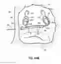 Fig. 66 - Systems, devices and methods for treating the heart with ablation