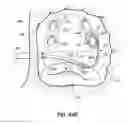 Fig. 70 - Systems, devices and methods for treating the heart with ablation