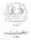 Fig. 72 - Systems, devices and methods for treating the heart with ablation