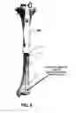Fig. 07 - Knee arthroplasty apparatus and method