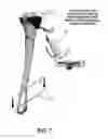 Fig. 08 - Knee arthroplasty apparatus and method