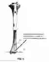 Fig. 09 - Knee arthroplasty apparatus and method