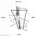 Fig. 07 - Method and apparatus for performing multidirectional tibial tubercle transfers