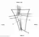 Fig. 09 - Method and apparatus for performing multidirectional tibial tubercle transfers