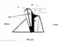 Fig. 22 - Method and apparatus for performing multidirectional tibial tubercle transfers