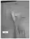 Fig. 28 - Method and apparatus for performing multidirectional tibial tubercle transfers
