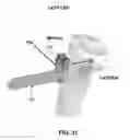 Fig. 32 - Method and apparatus for performing multidirectional tibial tubercle transfers