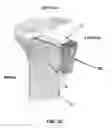 Fig. 33 - Method and apparatus for performing multidirectional tibial tubercle transfers