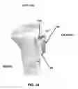 Fig. 35 - Method and apparatus for performing multidirectional tibial tubercle transfers