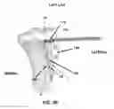 Fig. 37 - Method and apparatus for performing multidirectional tibial tubercle transfers