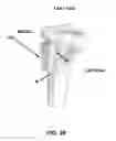 Fig. 40 - Method and apparatus for performing multidirectional tibial tubercle transfers