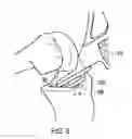 Fig. 04 - Surgical impactor