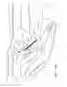 Fig. 14 - Endoscopic tissue anchor deployment