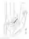 Fig. 18 - Endoscopic tissue anchor deployment