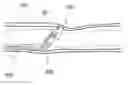 Fig. 01 - Systems and methods for remote endarterectomy