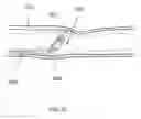 Fig. 16 - Systems and methods for remote endarterectomy