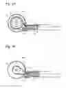 Fig. 04 - Vessel occlusive device and method of occluding a vessel
