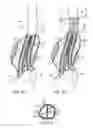 Fig. 08 - Methods and Systems for Treating Aneurysms