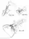 Fig. 19 - Methods and Systems for Treating Aneurysms