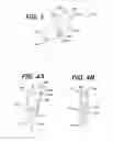 Fig. 03 - BIOABSORBABLE SUTURE ANCHOR SYSTEM FOR USE IN SMALL JOINTS