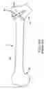 Fig. 02 - EXPANDABLE FACET SCREW