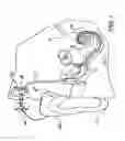 Fig. 02 - Hybrid cochlear implant