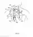 Fig. 06 - Charged grafts and methods for using them