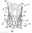 Fig. 01 - Methods of treating a native aortic valve insufficiency
