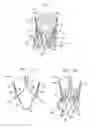Fig. 02 - Methods of treating a native aortic valve insufficiency
