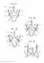 Fig. 04 - Methods of treating a native aortic valve insufficiency