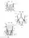 Fig. 05 - Methods of treating a native aortic valve insufficiency