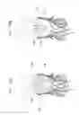 Fig. 16 - Methods of treating a native aortic valve insufficiency