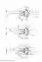 Fig. 24 - Methods of treating a native aortic valve insufficiency