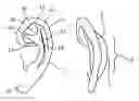 Fig. 01 - Ear molding device for correcting misshaped ears
