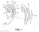 Fig. 02 - Ear molding device for correcting misshaped ears