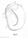 Fig. 05 - Ear molding device for correcting misshaped ears