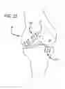 Fig. 14 - Joint support and subchondral support system
