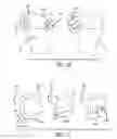 Fig. 17 - Joint support and subchondral support system