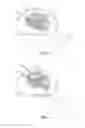 Fig. 05 - Interbody containment implant