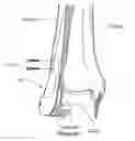 Fig. 01 - Malleolar replacement devices