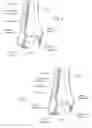 Fig. 02 - Malleolar replacement devices